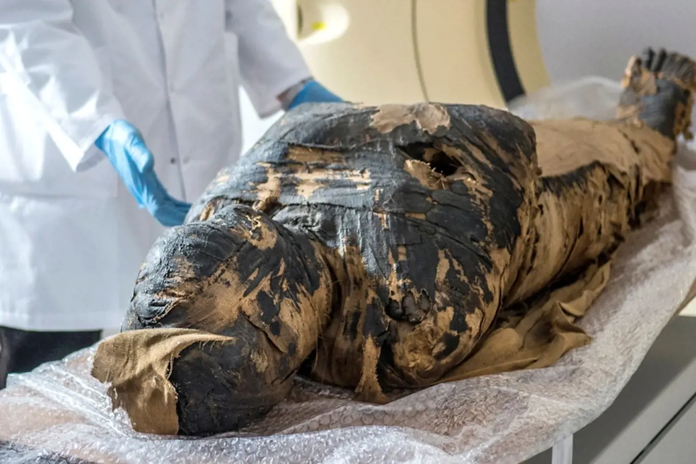 Těhotná mumie zemřela na rakovinu nosohltanu