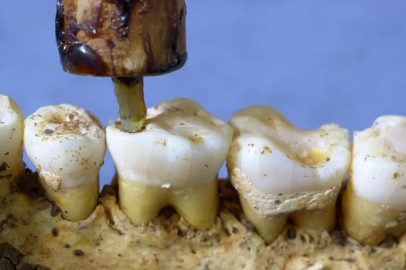 Rekonstrukce vrtání zubu pravěkým nástrojem