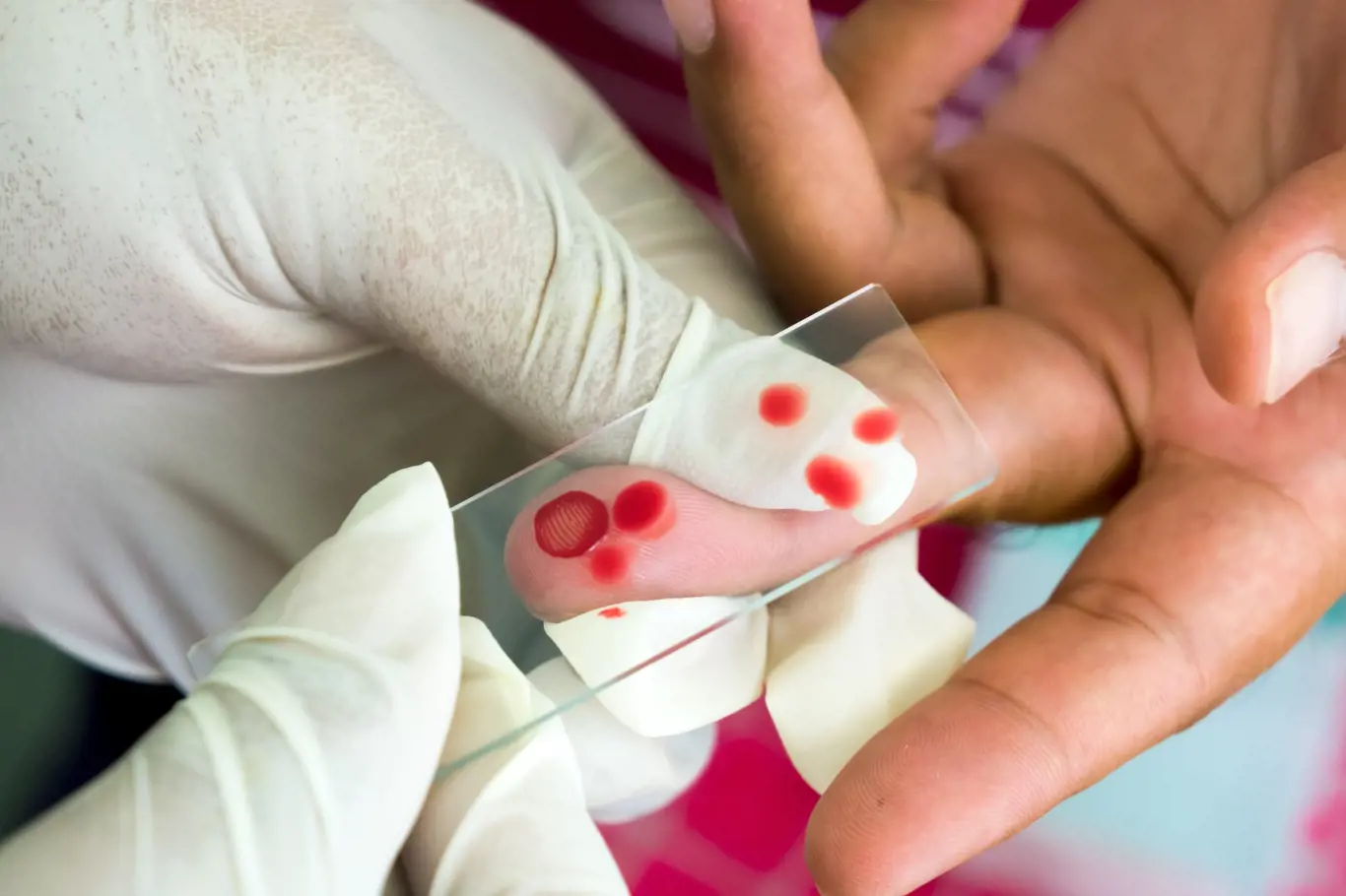 Test na malárii. Stačí kapka krve