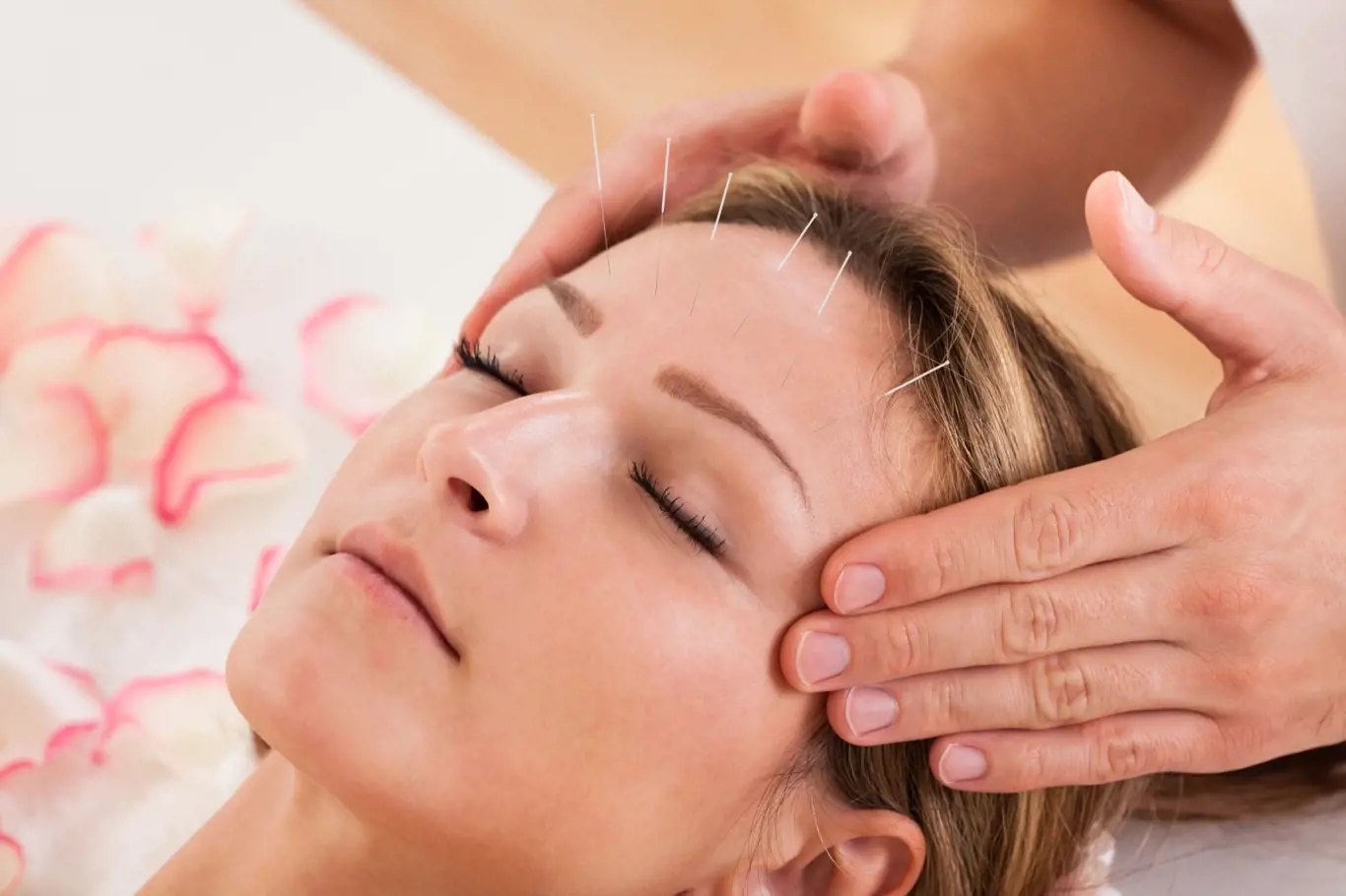 Akupunktura pomáhá s příznaky menopauzy