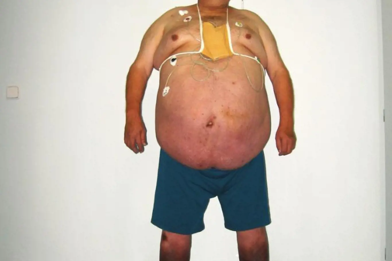 <p>Takto si muže vyfotili lékaři ve valašskomeziříčské nemocnici v době, kdy ještě vážil 216 kilogra