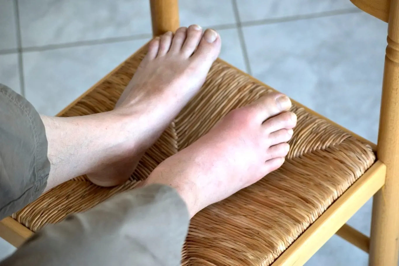 Dna se projevuje nejčastěji bolestí kloubu palce u nohy.