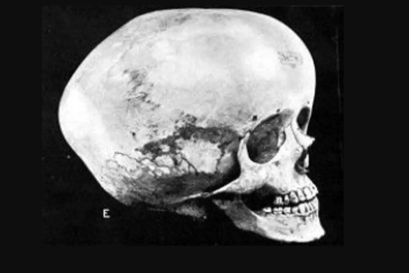 Hydrocefalická lebka často falešně prezentovaná jako boskopoidní lebka