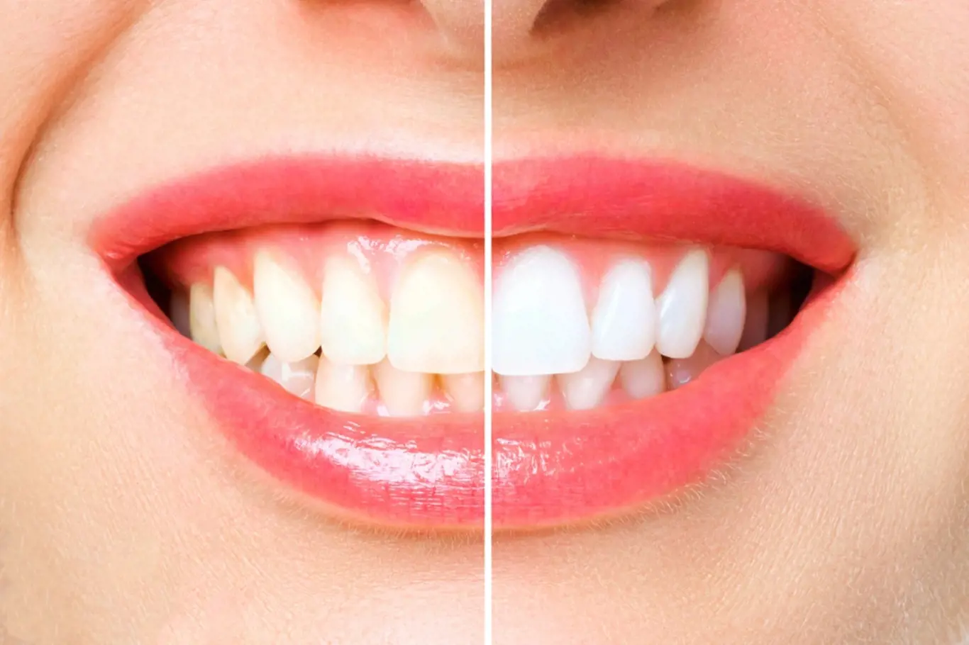 Bílé zuby domácí metodou