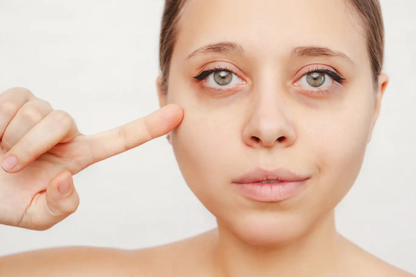A young caucasian woman pointing dark circles under the eyes with her finger. Bruises under the eyes are caused by fatigue, nervousness, lack of sleep, insomnia and stress. Skin care, cosmetology