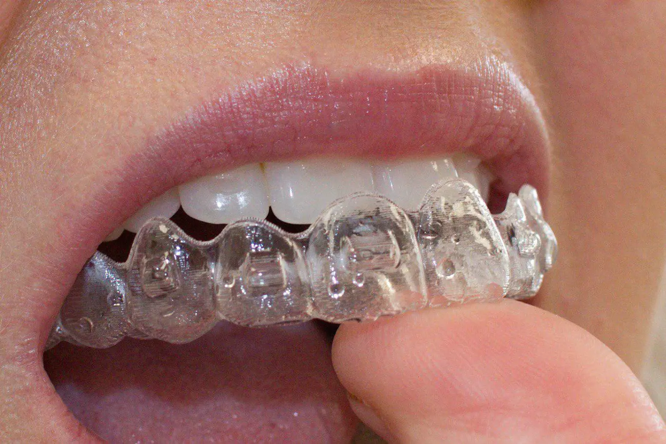 Rovné zuby jsou nejen hezké, jsou i zdravé