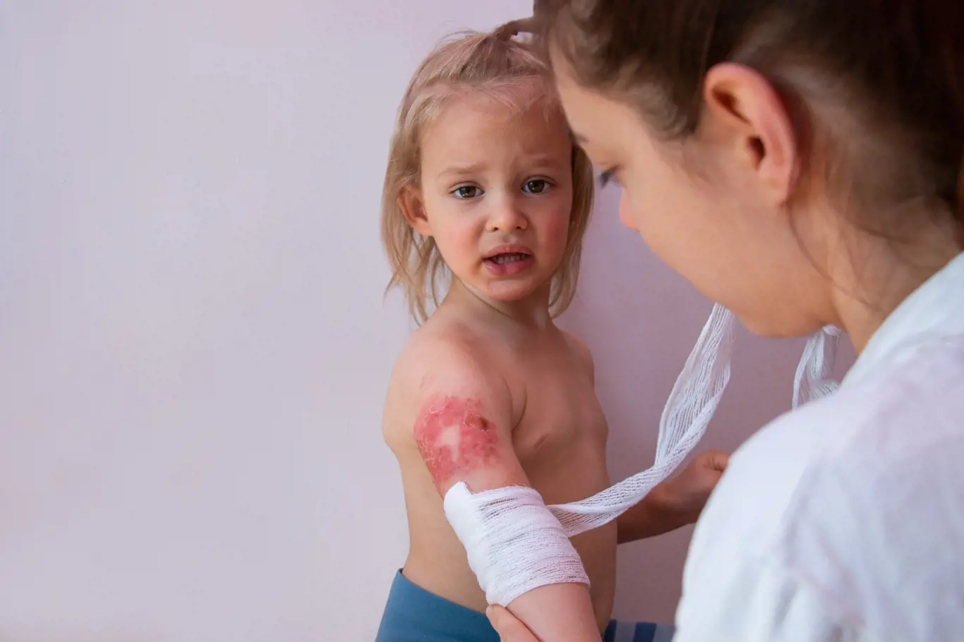lékař ošetřuje popálené dítě
