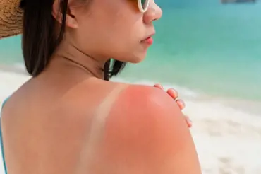 9 babských rad, jak ulevit pokožce popálené od sluníčka