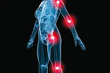 Revmatoidní artritida: příznaky a léčba zánětu kloubů