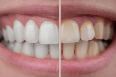 Jak vybělit zuby zadarmo? Američanky používají běžné slupky od ovoce