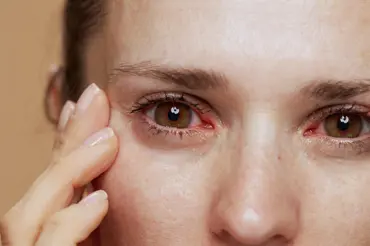 Syndrom suchého oka může souviset se systémovým onemocněním
