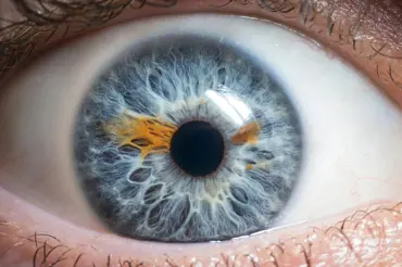 Jaké nemoc se dají vyčíst z barvy oční duhovky?