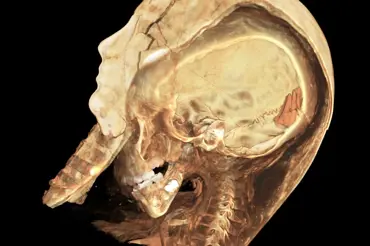Sken mumie Tutanchamona odhalil zvláštní anomálii v lebce. Podívejte se na video
