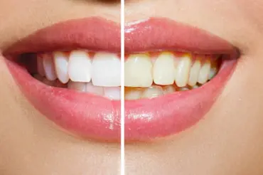 Jak vybělit zuby až o dva odstíny doma a bez chemie? Zkuste kurkumu. Funguje!
