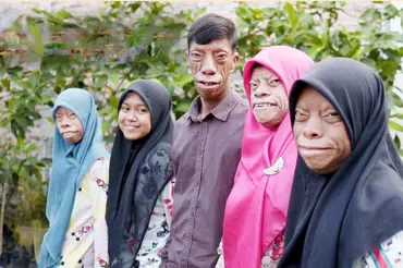 Ještěří lidé: V rodině ze Sumatry putuje záhadný gen. Jeho nositelé mají tvář podobnou ještěrům