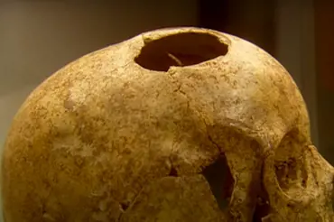 Nález starověké lebky lukostřelce šokoval vědce. Mění vše, co si dosud mysleli o mozkové chirurgii