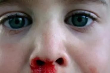 Dítěti teče krev z nosu: Jak reagovat?