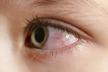 Pálení a slzení očí: možné příčiny a léčba