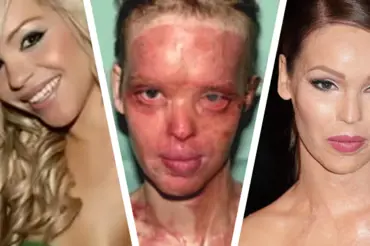 Katie Piper (33) znetvořil obličej útok kyselinou ze žárlivosti. Jak vypadá bývalá modelka?