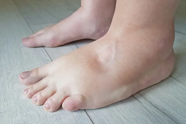Nepodceňte otékající nohy: mohou signalizovat tři vážně nemocné orgány