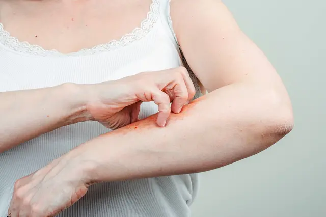 Jsou všude: Tato malá bestie kouše a letos v létě se objevuje v hojném počtu