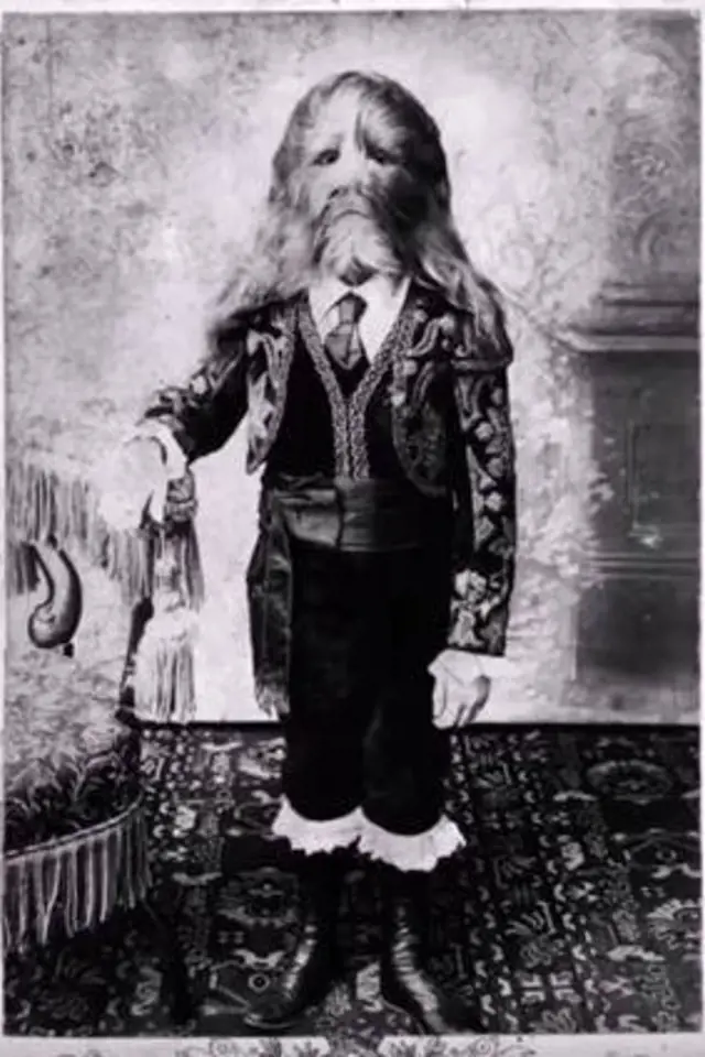 Stephan Bibrowsky vystupoval jako Muž se lví tváří. Zemřel ve svých 42 letech, celý život strávil v cirkuse.