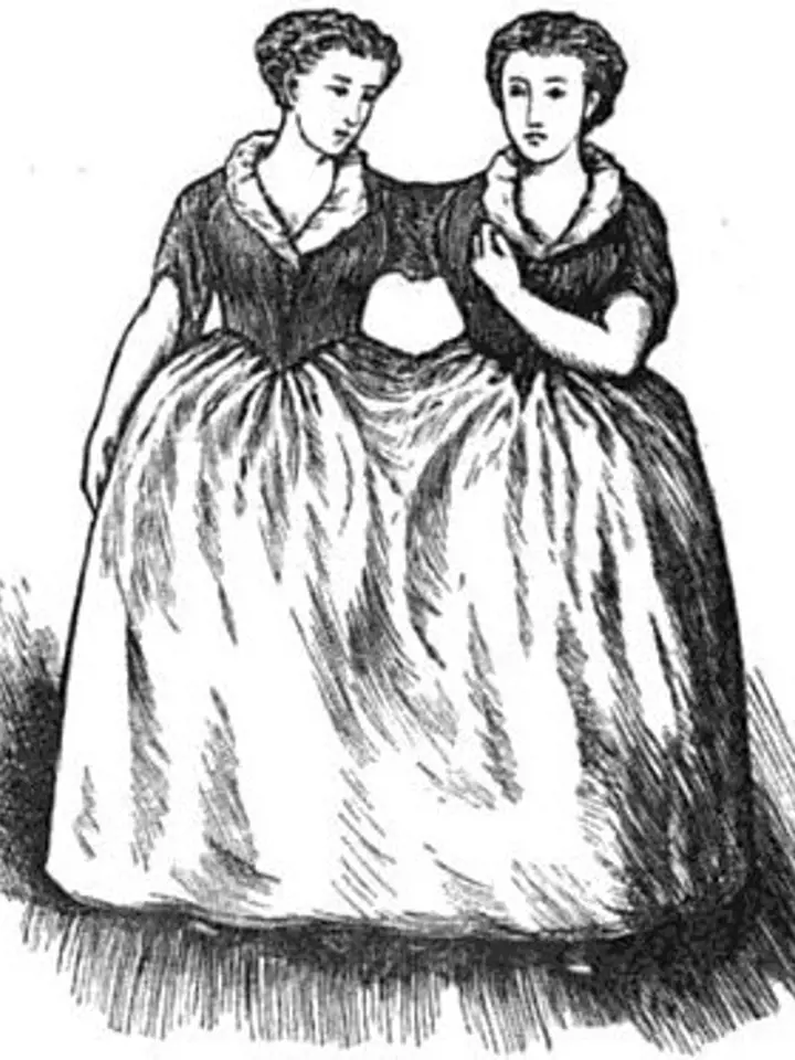 O siamská dvojčata z Biddendenu vzrostl zájem v 19. století.