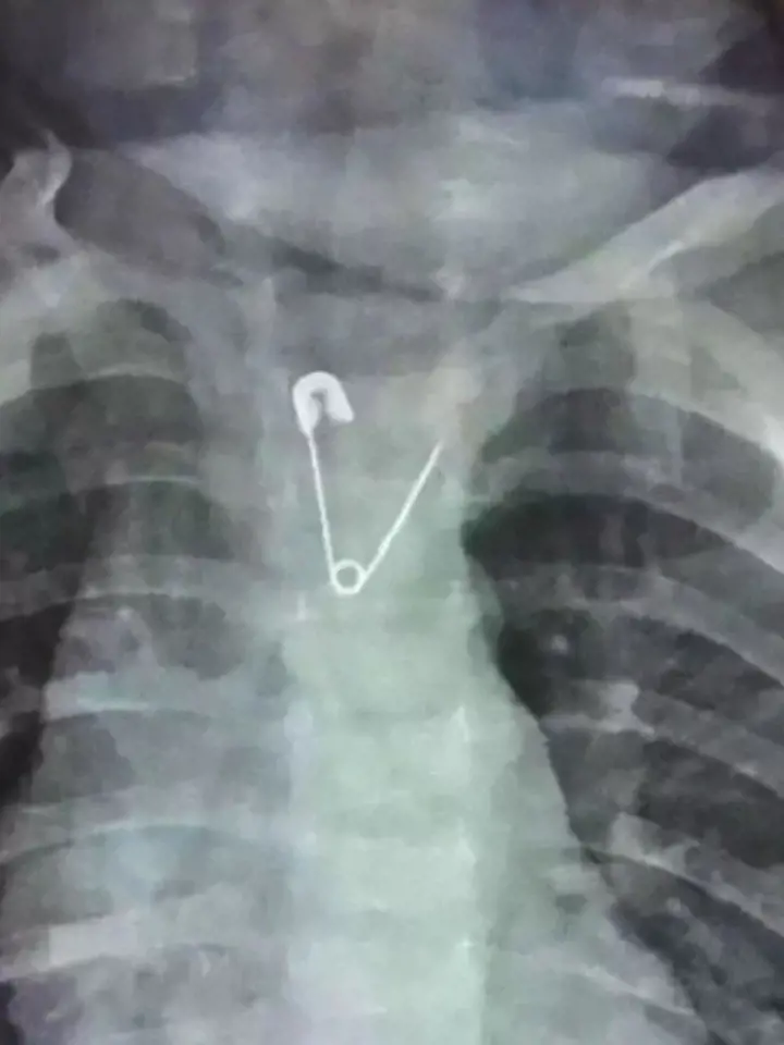 Toto čínské děťátko spolklo otevřený svírací špendlík, kterým mělo sepnutou plenu. Naštěstí se lékařům podařilo špendlík z těla přes ústa opatrně dostat ven.