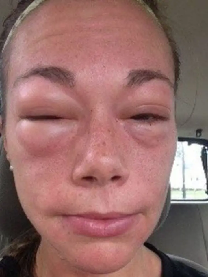 Alergie na oční krém.