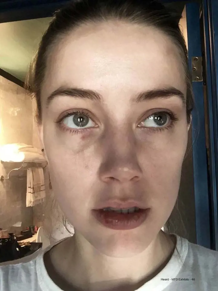 Amber Heard ukazuje pohmožděniny, které jí měl Depp způsobit