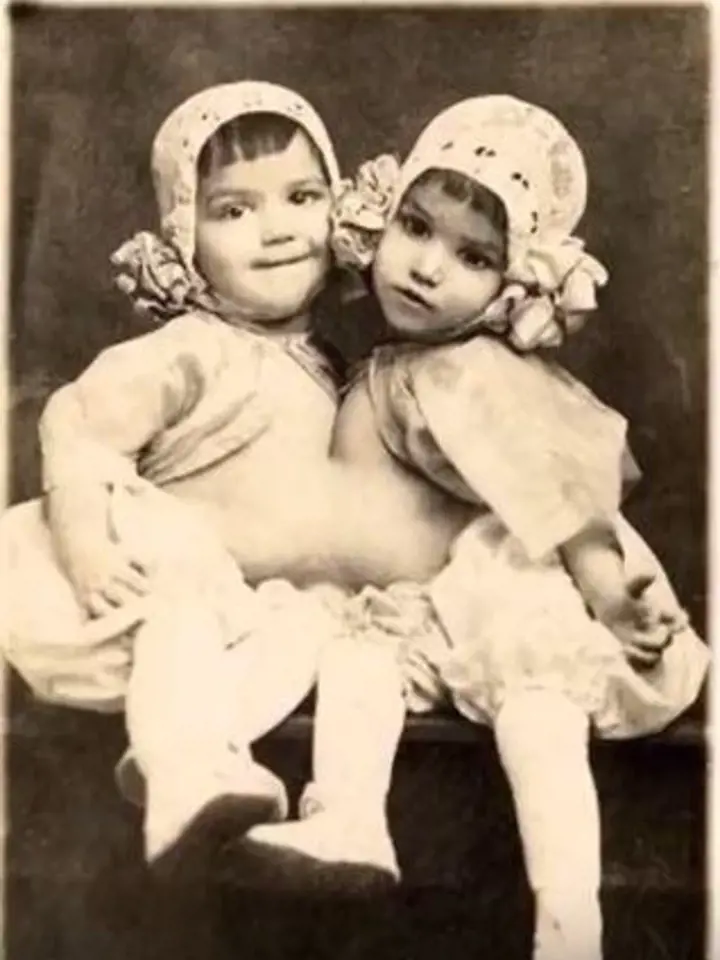 Guadalupe a Josephnie Hinojosa - siamská dvojčata, která rodiče prodali do cirkusu.