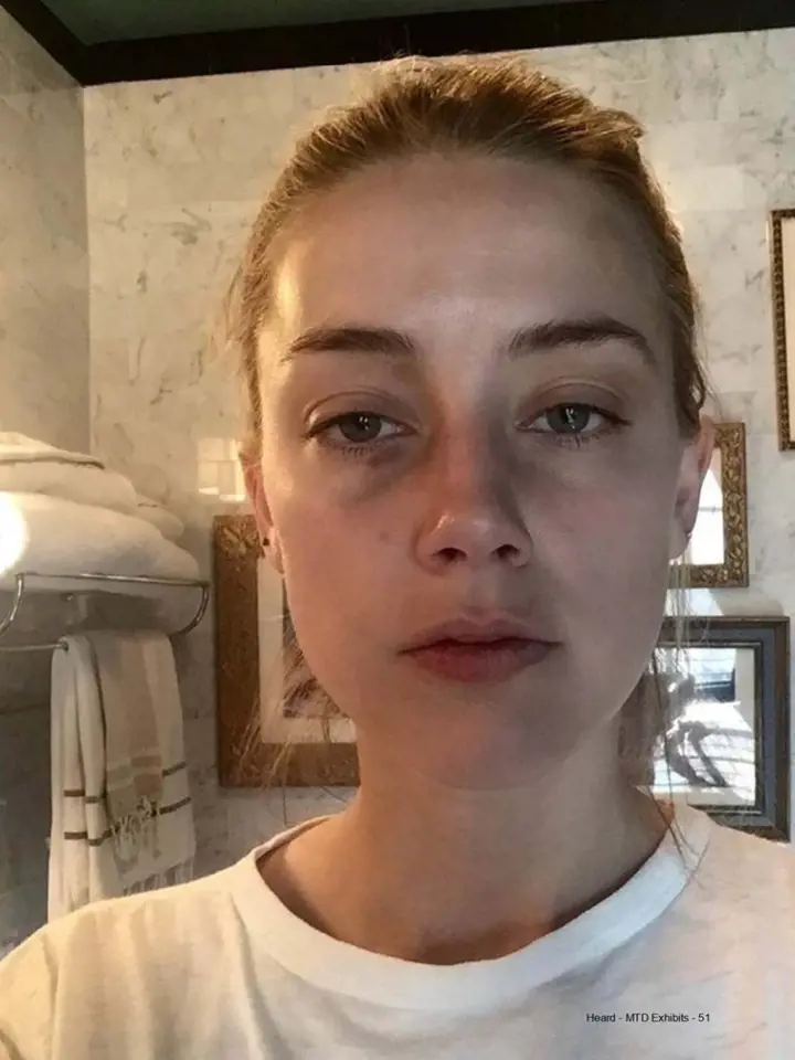 Amber Heard ukazuje pohmožděniny, které jí měl Depp způsobit