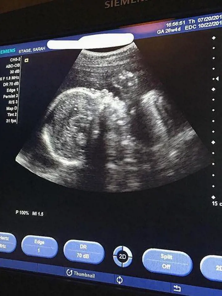 Sarah musela uveřejnit rentgenový snímek svého miminka, aby jí někteří vůbec uvěřili, že je těhotná.