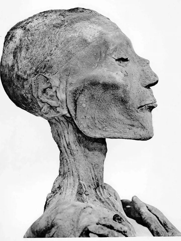 Mumie faraona Ramesse V. vykazuje typické známky neštovic.