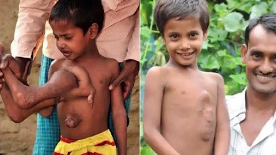 Deepak Paswan - Indický chlapec se narodil s parazitickým dvojčetem, které mu vyrůstalo z břicha. Naštěstí se ale dostal do péče odborníků a dnes je z něj úplně normální kluk.