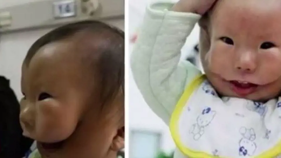 Rozštěp tváře - v roce 2010 se v Číně narodil chlapec s unikátní vadou, vypadá jako by měl dvě tváře. Jde jen o fyzické postižení, po mentální stránce je zcela v pořádku. Až doroste do určitého věku, podstoupí složitou opera...