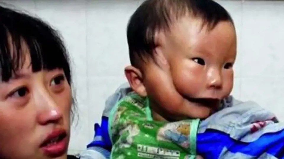 Rozštěp tváře - v roce 2010 se v Číně narodil chlapec s unikátní vadou, vypadá jako by měl dvě tváře. Jde jen o fyzické postižení, po mentální stránce je zcela v pořádku. Až doroste do určitého věku, podstoupí složitou opera...