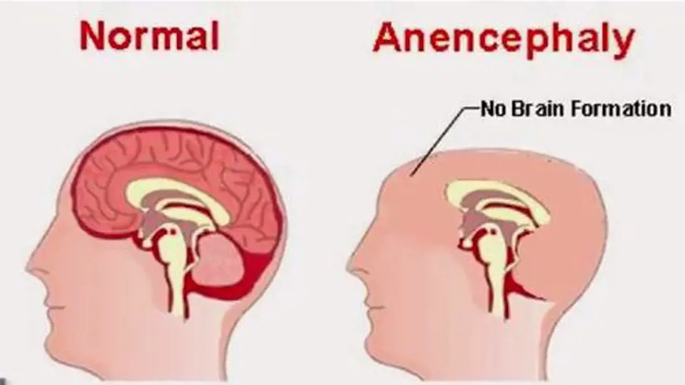 Anencephaly je vada, při které novorozencům chybí část lebky a velká část mozku. Hlavička je tedy mnohem menší, než je obvyklé a všichni takto postižení jedinci mají podobný obličej, ve kterém dominují vypouklé oči. Bohužel nov...