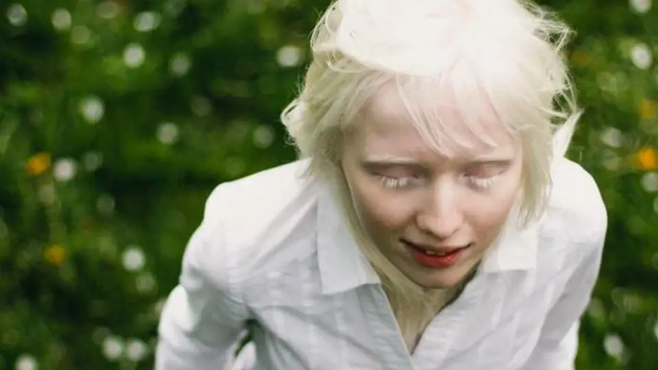 Nastya Zhidkova je albínka bez jediné špetky pigmentu. Světlé má vlasy, obočí, řasy i oči.