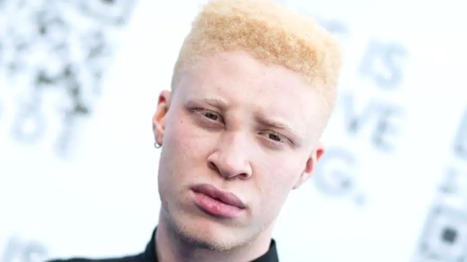 Shaun Ross je albín.