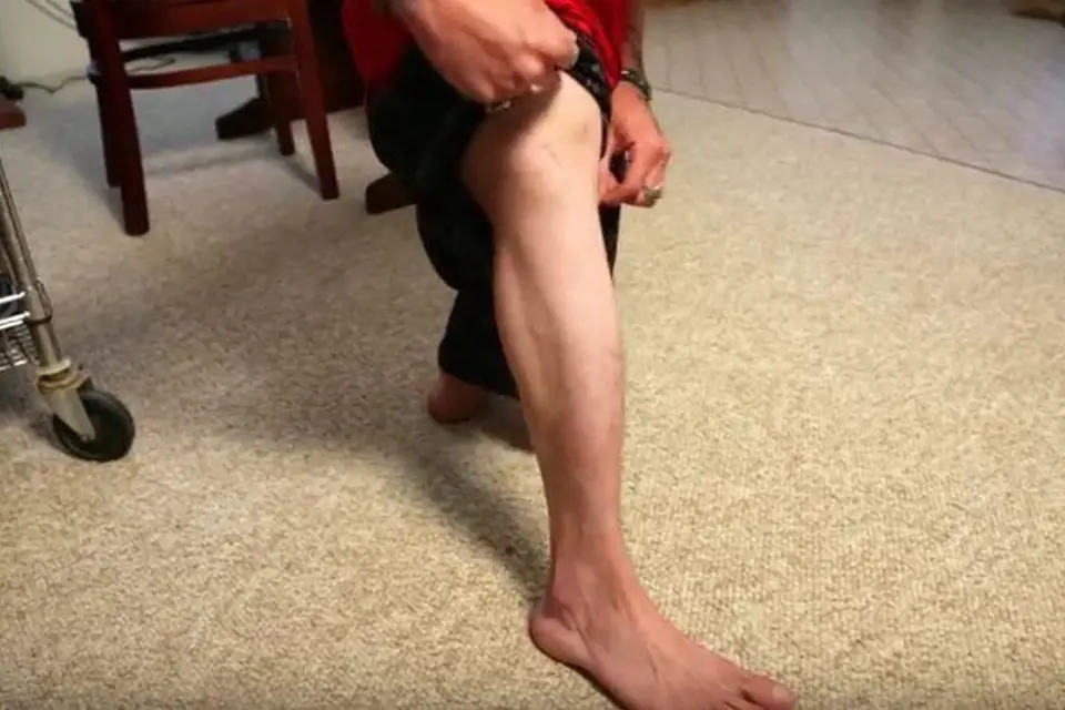 Nathan nema stehenní kost, kolena mu vyrůstají rovnou z kyčle.
