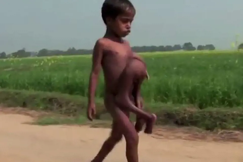 Deepak Paswan - Indický chlapec se narodil s parazitickým dvojčetem, které mu vyrůstalo z břicha. Naštěstí se ale dostal do péče odborníků a dnes je z něj úplně normální kluk.