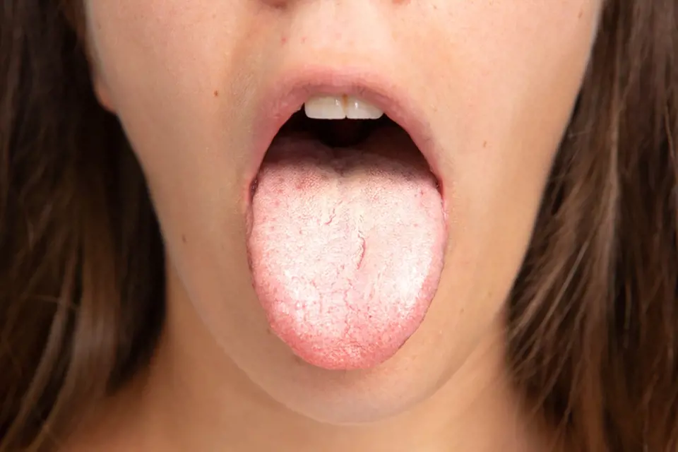Bílý povlak na jazyku věstí přemnožené bakterie