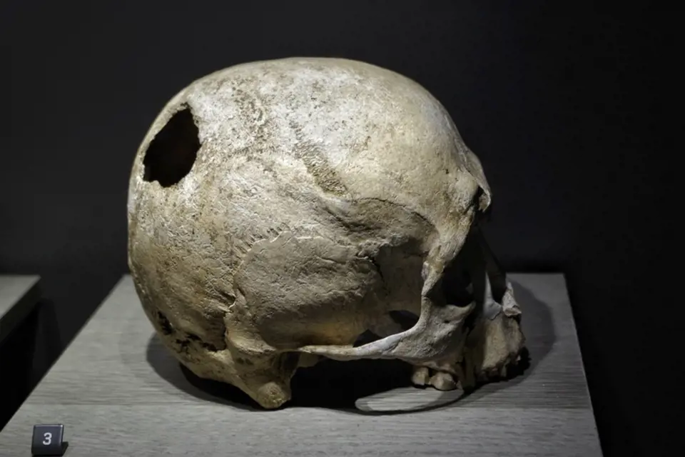 Lebka s otvorem po trepanaci z 2.-3. tisíciletí př. n. l.