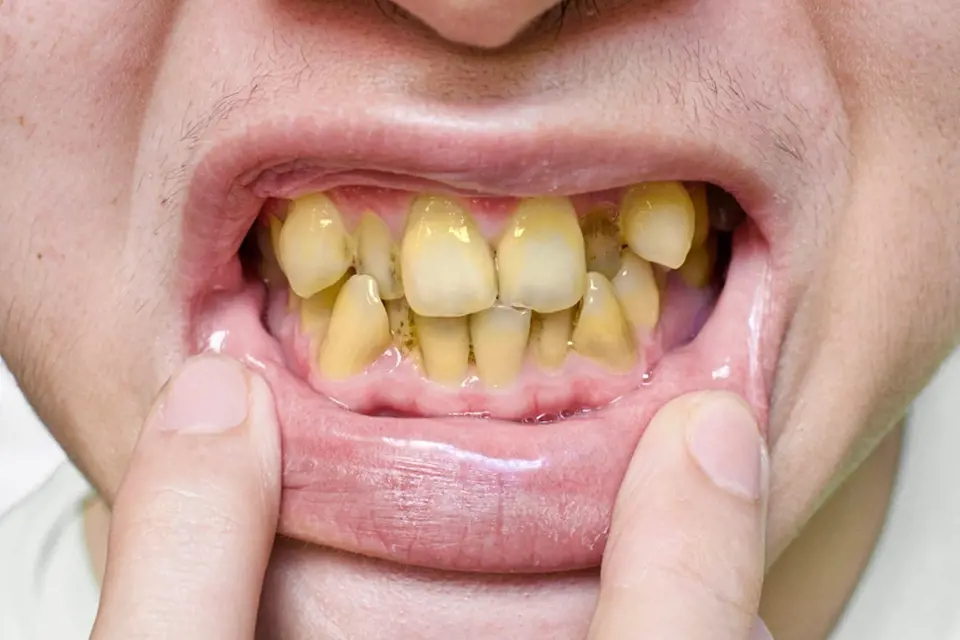 Nepěkné zbarvení zubů způsobuje kouření cigaret.