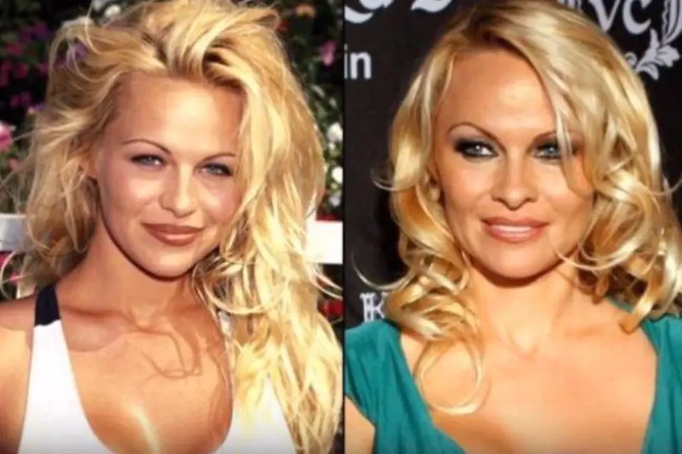 Pamela Anderson je průkopnicí v oblasti plastických operací! Před ní se o plastikách prsou skoro nemluvilo.