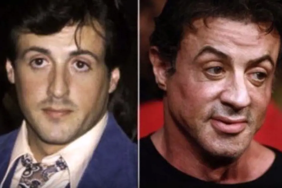 Sylvester Stallone bude mít brzy obočí až k vlasům, což je důsledek mnoha botoxových injekcí.