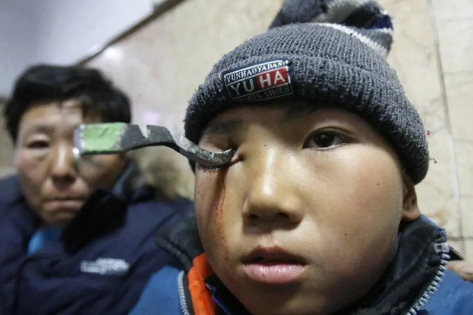 Třináctiletý čínský chlapec může děkovat štěstěně, že tuto nehodu přežil! Během hraní na školním hřišti, upadl a nabodl se na kovový hák. Ten zůstal jen 2 milimetry od mozku, který tak naštěstí neporanil.
