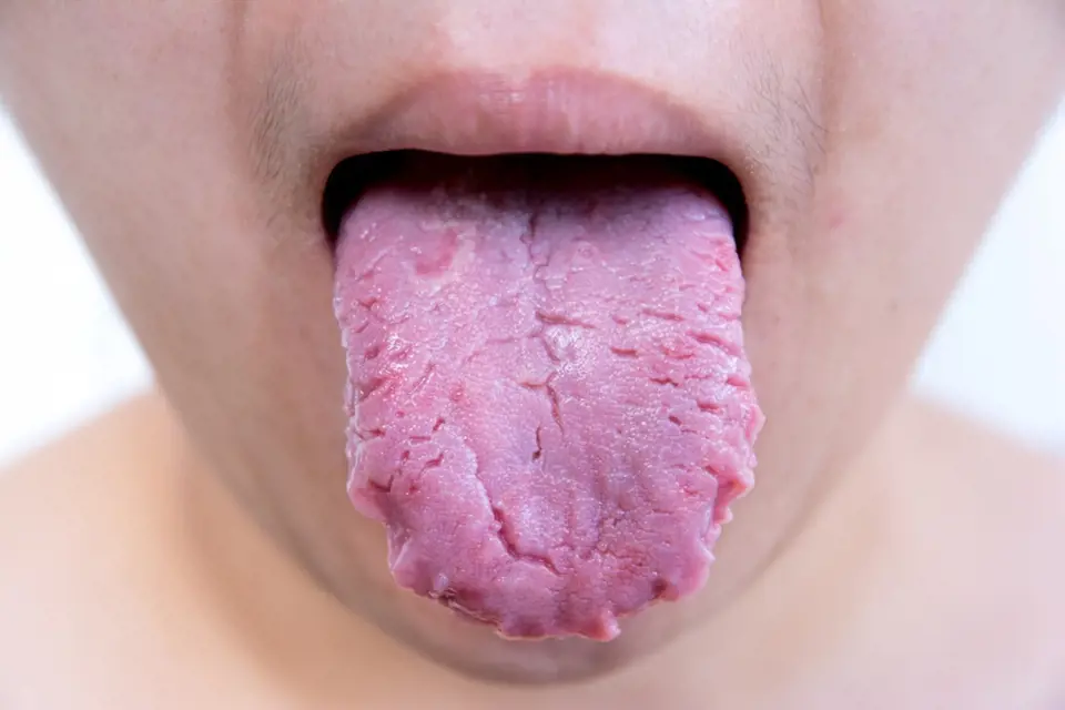Přemožené bakterie na jazyku se poznají na první pohled