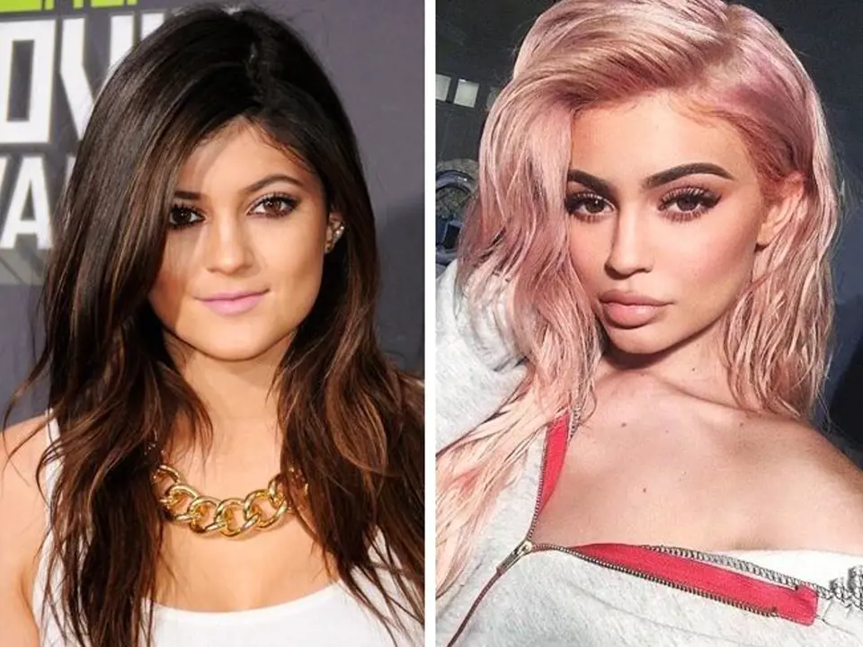 Kylie Jenner, 20: Proměna Kylie Jenner je kapitola sama pro sebe. Tato dívka si připadal z celého klanu Kardashianů a Jennerů nejošklivější a tak ještě před osmnáctými narozeninami podstoupila svou první plastiku obličeje. Kylie má no...